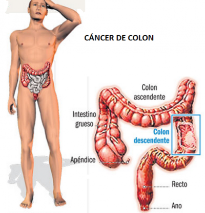 cncer_colon_01mar13